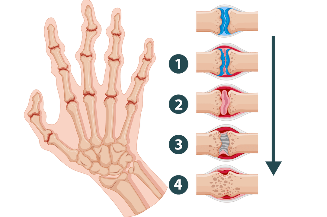 Faze razvoja artritisa - upalna oštećenja zglobova