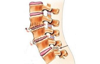 Spondilarthrosis kao uzroci bolova u leđima