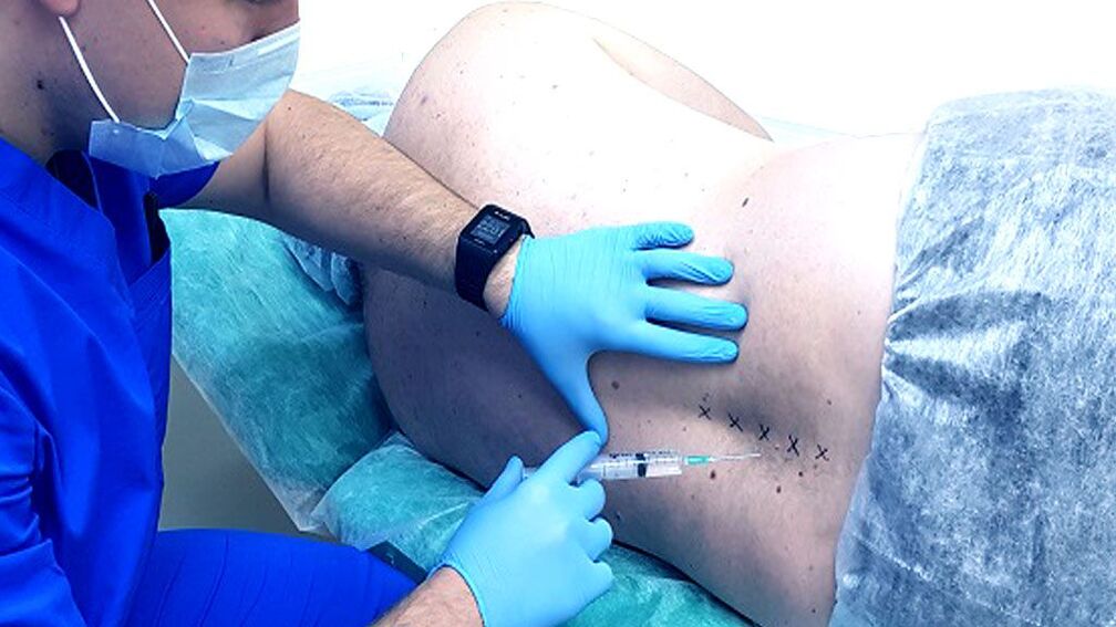 Spinalni blok za osteohondrozu