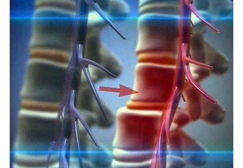 Kompresija živčanih završetaka u lumbalnoj osteohondrozi