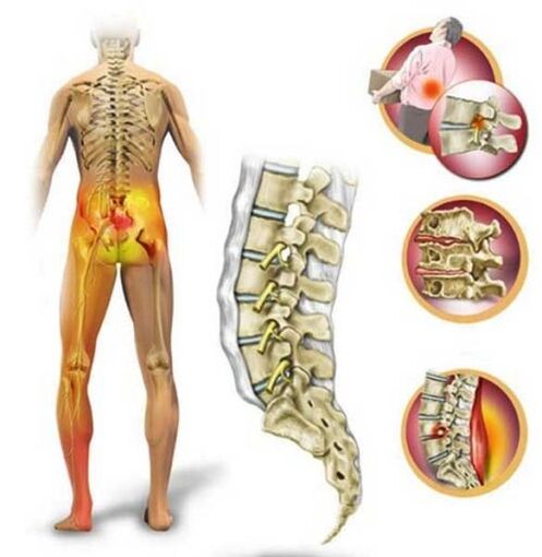 Osteokondroza lumbalne kralježnice, koja uzrokuje bol u donjem dijelu leđa