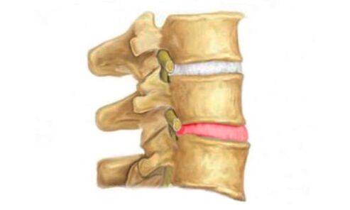 Protruzija intervertebralnog diska kralježnice - znak osteohondroze